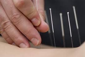 acupuncture是什么意思