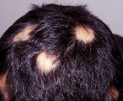 alopecia是什么意思