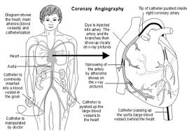 angiography是什么意思