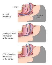 apnea是什么意思