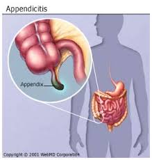 appendicitis是什么意思