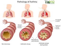 asthma是什么意思