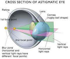 astigmatic是什么意思
