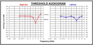 audiometry是什么意思