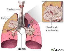 carcinoma是什么意思