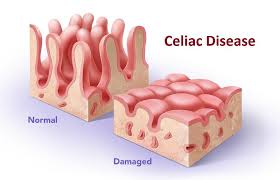 celiac是什么意思