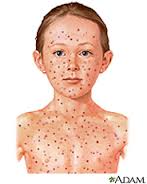 chickenpox是什么意思