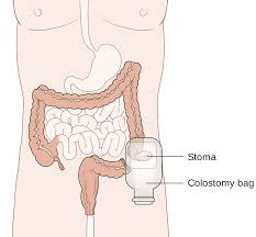 colostomy是什么意思