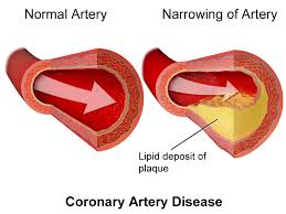 coronary是什么意思