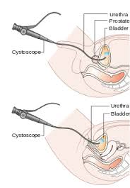 cystoscopy是什么意思