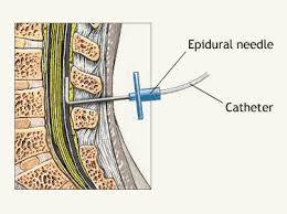 epidural是什么意思