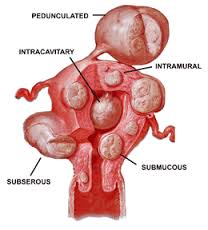 fibroid是什么意思