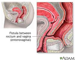 fistula是什么意思