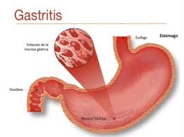 gastritis是什么意思