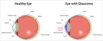 glaucoma是什么意思