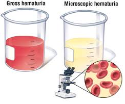 hematuria是什么意思