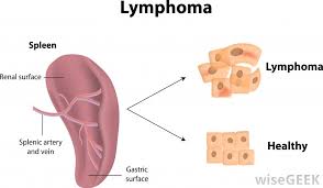 lymphoma是什么意思