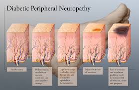 neuropathy是什么意思