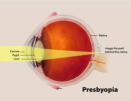 presbyopia是什么意思