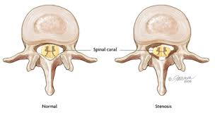 stenosis是什么意思