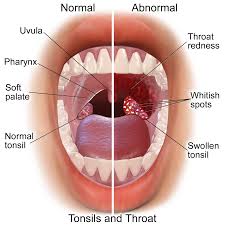 tonsillitis是什么意思