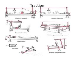 traction是什么意思