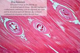 trichinosis是什么意思