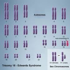 trisomy是什么意思