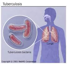 tuberculosis是什么意思