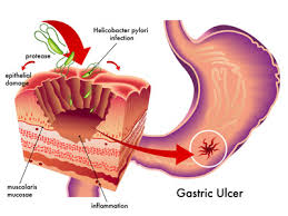 ulcer是什么意思