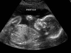 ultrasound是什么意思
