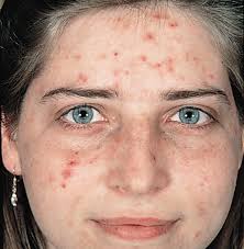 acne是什么意思