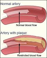 arteriosclerosis是什么意思