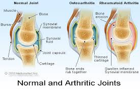arthritis是什么意思