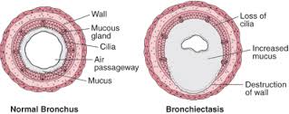 bronchiectasis是什么意思