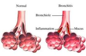 bronchitis是什么意思