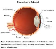 cataract是什么意思