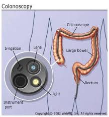 colonoscopy是什么意思