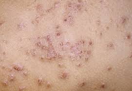 eczema是什么意思