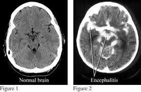encephalitis是什么意思