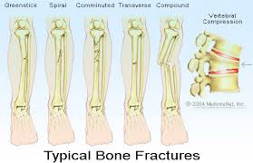 fracture是什么意思