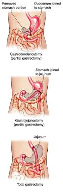 gastrectomy是什么意思
