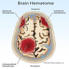 hematoma是什么意思