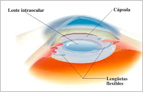 intraocular是什么意思
