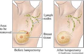 lumpectomy是什么意思