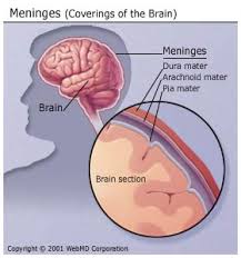 meningitis是什么意思