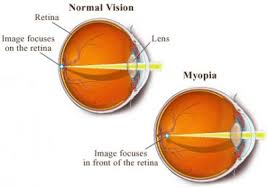 myopia是什么意思