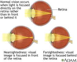 nearsighted是什么意思