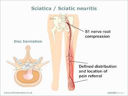 neuritis是什么意思