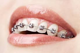 orthodontics是什么意思